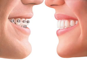 Cincinnati Invisalign